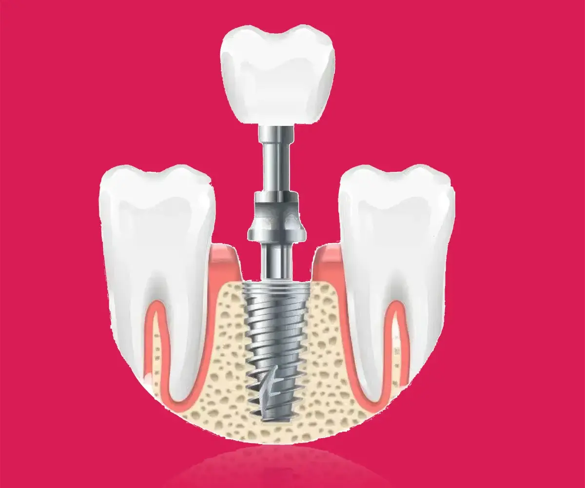 Dental Implant Treatment in Gurgaon