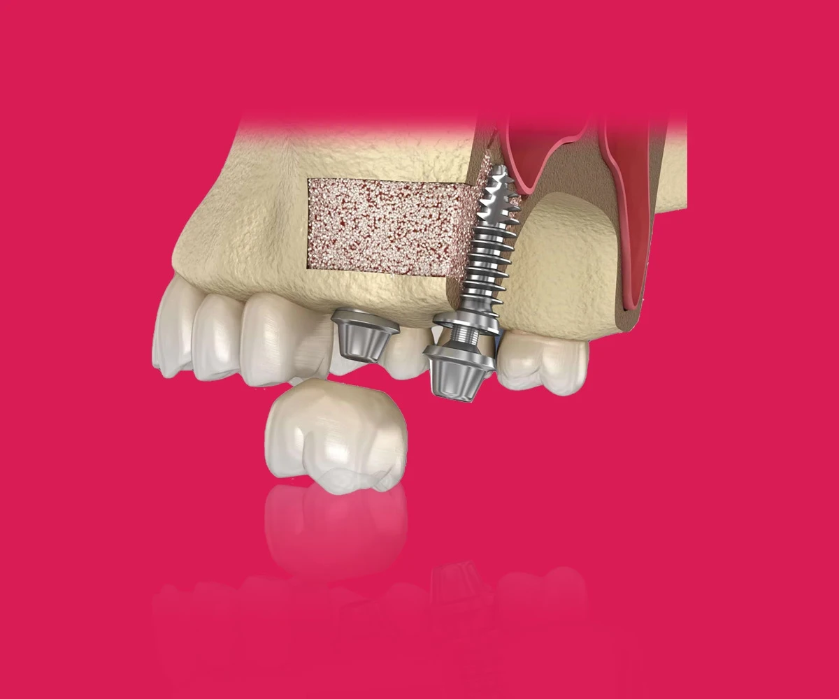 Bone Grafting and Sinus Procedures