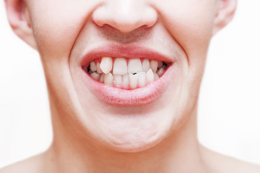 Crooked teeth alignment and treatment illustration