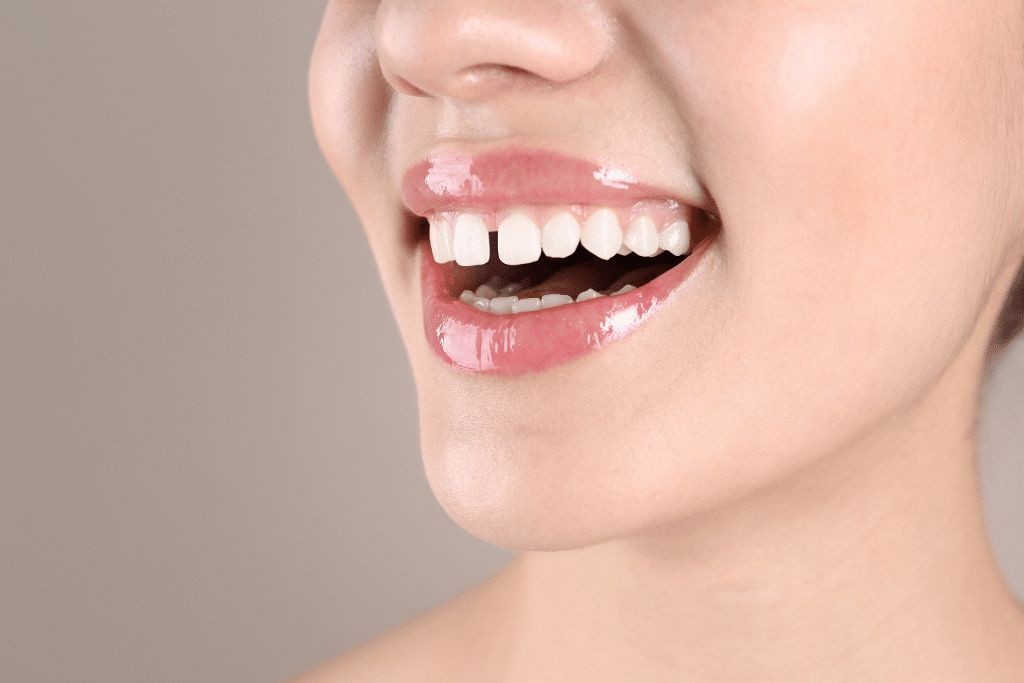 Teeth Gaps