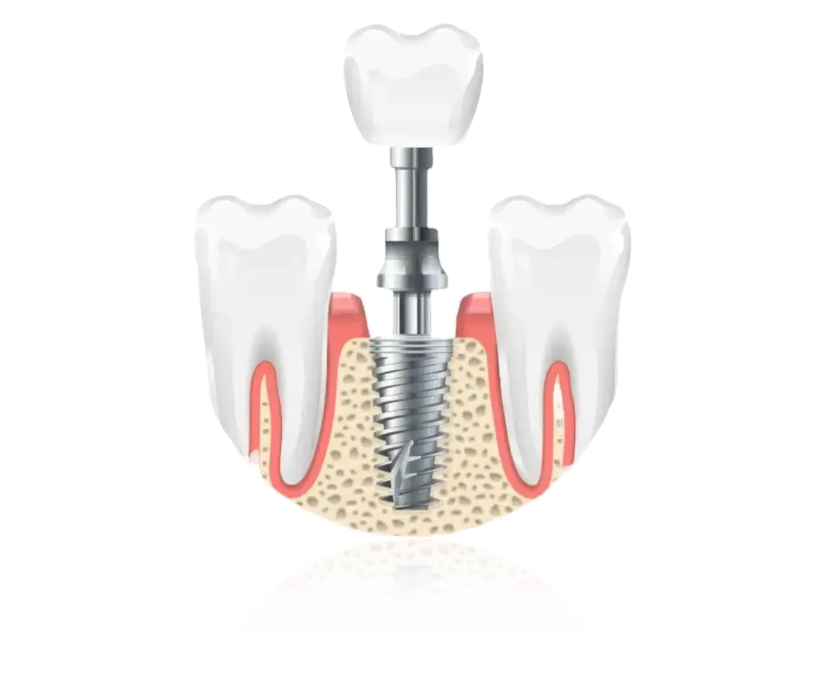 Dental Implant Treatment in Gurgaon